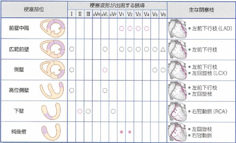 心電図⑦ 冠動脈と心筋梗塞（後半） | 医師の心電図ブログ