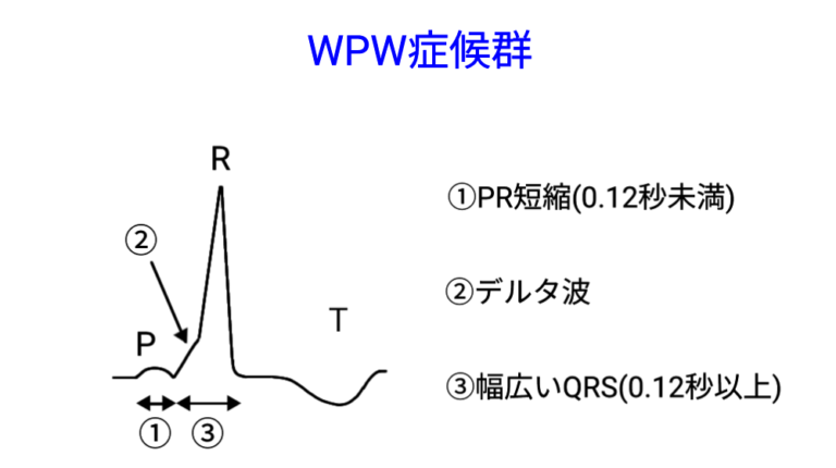 心電図⑤ PR時間の異常(PR延長、WPW症候群、LGL症候群) | 医師の心電図ブログ