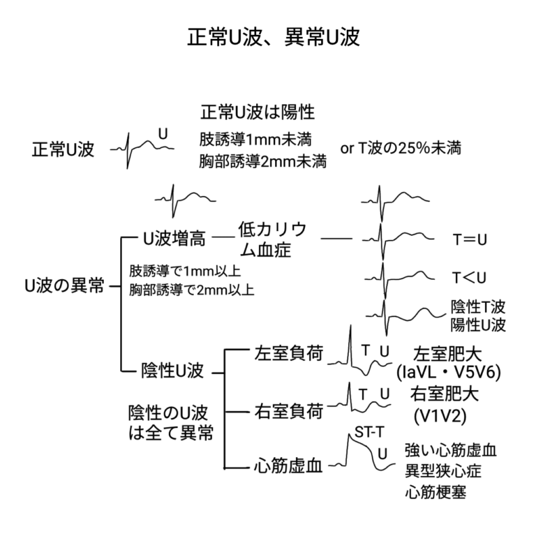 心電図⑬ QT延長とTdP、U波 | 医師の心電図ブログ