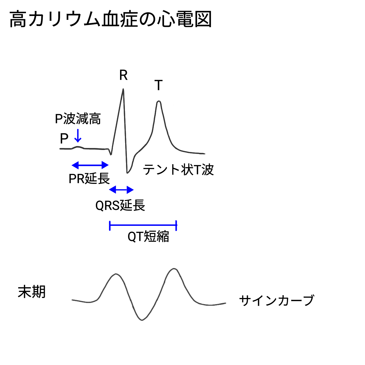 心電図⑭ 電解質異常（高カリウム・低カリウム・カルシウム異常） | 医師の心電図ブログ