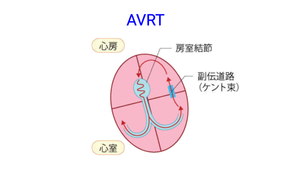 不整脈③ 発作性上室性頻拍(PSVT)と心房頻拍 | 医師の心電図ブログ