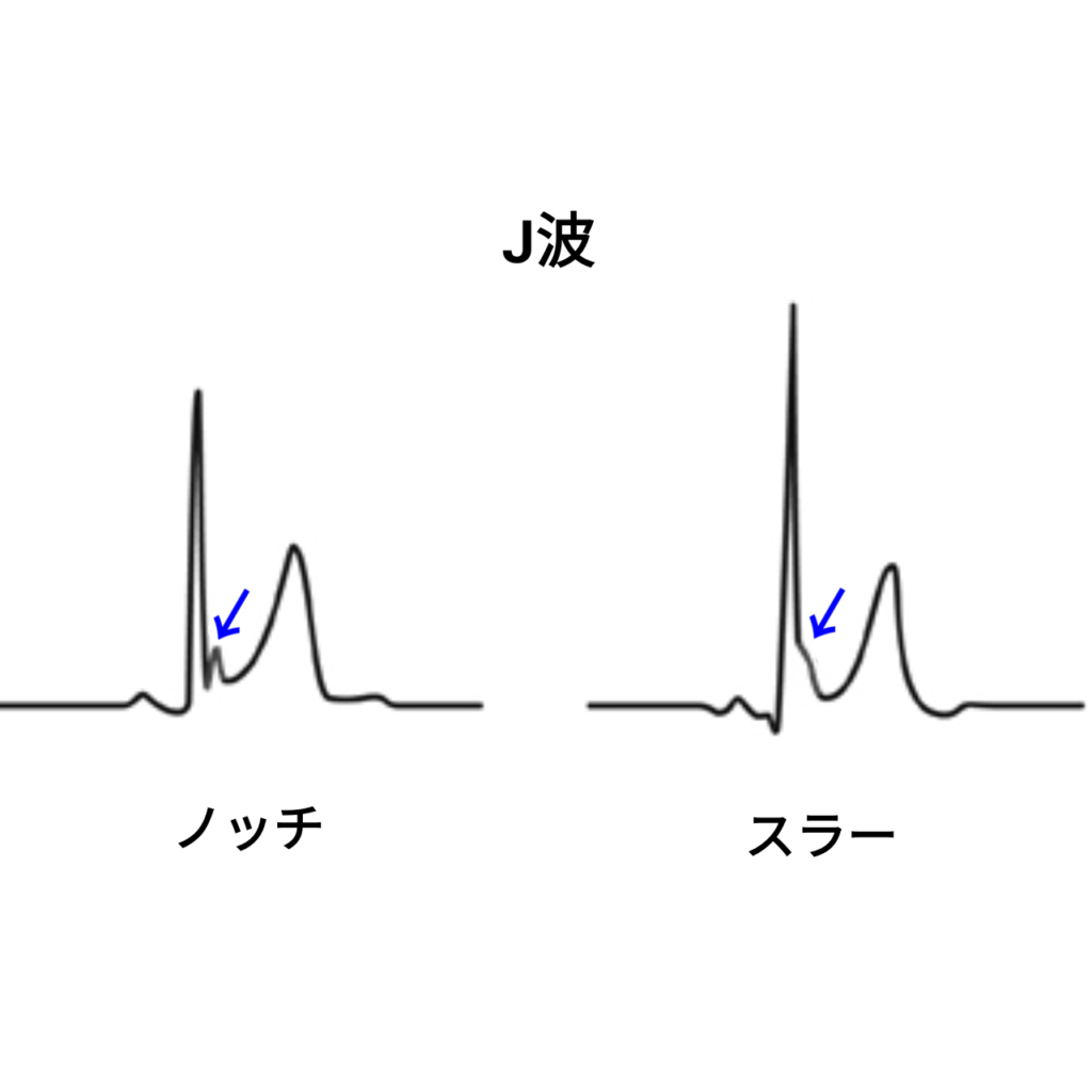 心電図S波とは – 心電図 波形 種類 | 心電図s波とは について掘り下げる心電図の簡単なポイント – TKQBW