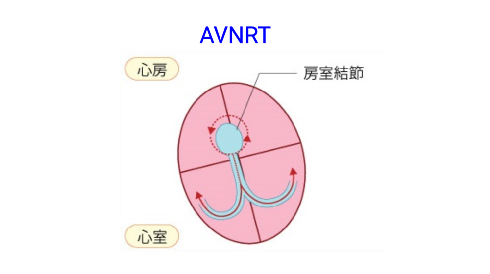 不整脈③ 発作性上室性頻拍(PSVT)と心房頻拍 | 医師の心電図ブログ